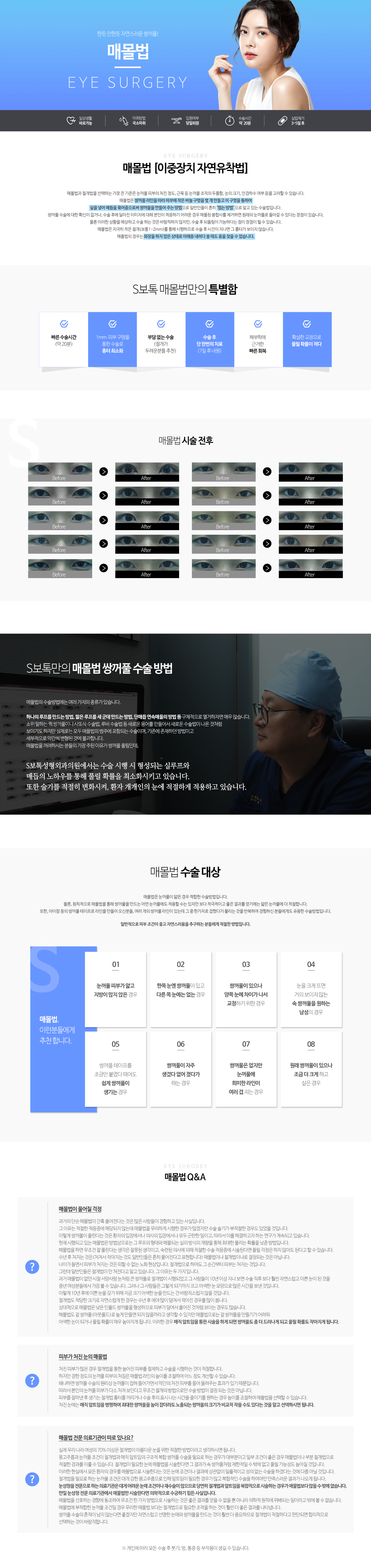 매몰법