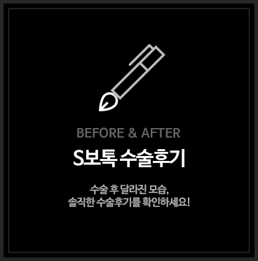 S보톡 수술후기